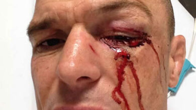 Photo of Fractura grave para Jhon Wayne Parr