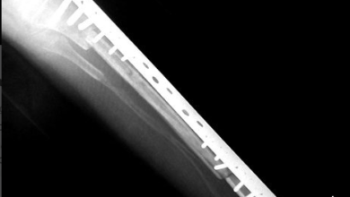 Photo of Luchador suspendido por usar implantes de titanio en la tibias
